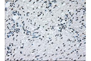 Immunohistochemical staining of paraffin-embedded Adenocarcinoma of colon tissue using anti-BRAFmouse monoclonal antibody.