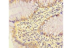 Immunohistochemistry of paraffin-embedded human colon cancer using ABIN7166969 at dilution of 1:100 (RABEP2 antibody  (AA 301-533))