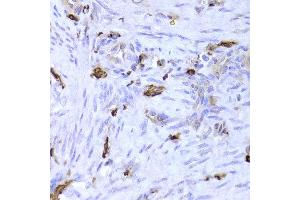Immunohistochemistry of paraffin-embedded Human adenomyosis using LSP1 antibody at dilution of 1:100 (x400 lens).