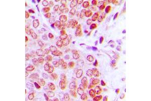 Immunohistochemical analysis of ZNF134 staining in human prostate cancer formalin fixed paraffin embedded tissue section. (ZNF134 antibody  (Center))