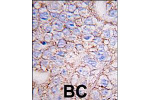 Formalin-fixed and paraffin-embedded human breast carcinoma tissue reacted with MAPK15 polyclonal antibody  , which was peroxidase-conjugated to the secondary antibody, followed by DAB staining. (MAPK15 antibody  (N-Term))