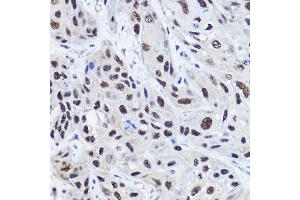Immunohistochemistry of paraffin-embedded human esophageal cancer using [KO Validated] NCO Rabbit pAb (ABIN6129656, ABIN6144413, ABIN6144414 and ABIN7101354) at dilution of 1:100 (40x lens). (NCOA2 antibody  (AA 550-820))