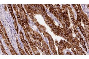 ABIN6267130 at 1/100 staining Human thyroid cancer tissue by IHC-P. (KRT20 antibody  (pSer13))