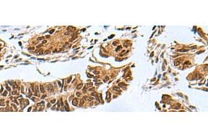 Immunohistochemistry of paraffin-embedded Human colorectal cancer tissue using PDCD5 Polyclonal Antibody at dilution of 1:55(x200) (PDCD5 antibody)