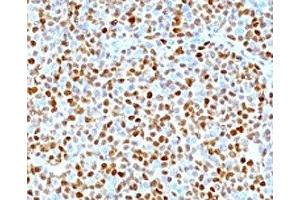 Formalin-fixed, paraffin-embedded human mantle cell lymphoma stained with CCND1 antibody. (Cyclin D1 antibody)