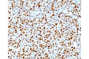 Formalin-fixed, paraffin-embedded human mantle cell lymphoma stained with CCND1 antibody. (Cyclin D1 antibody)