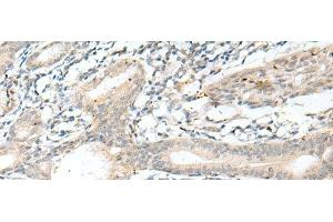 Immunohistochemistry of paraffin-embedded Human esophagus cancer tissue using NXNL1 Polyclonal Antibody at dilution of 1:45(x200) (NXNL1 antibody)