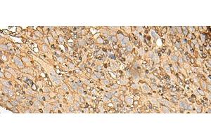 Immunohistochemistry of paraffin-embedded Human cervical cancer tissue using UBE2A Polyclonal Antibody at dilution of 1:45(x200) (UBE2A antibody)