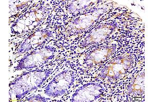 Formalin-fixed and paraffin-embedded : human colon carcinoma labeled with Rabbit Anti-WNK3 protein Polyclonal Antibody (ABIN675713), Unconjugated 1:200 followed by conjugation to the secondary antibody (WNK3 antibody  (AA 451-550))