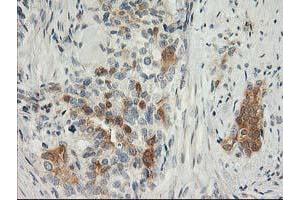 Immunohistochemical staining of paraffin-embedded Adenocarcinoma of Human breast tissue using anti-SNAP25 mouse monoclonal antibody. (SNAP25 antibody)