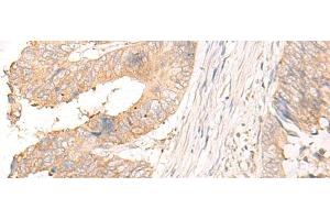 Immunohistochemistry of paraffin-embedded Human colorectal cancer tissue using MYDGF Polyclonal Antibody at dilution of 1:25(x200) (MYDGF antibody)