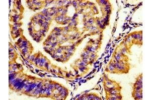 Immunohistochemistry of paraffin-embedded human endometrial cancer using ABIN7142644 at dilution of 1:100 (HTR7 antibody  (AA 1-83))
