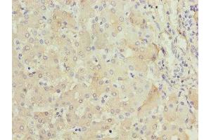 Immunohistochemistry of paraffin-embedded human liver tissue using ABIN7152640 at dilution of 1:100 (FABP1 antibody  (AA 1-127))