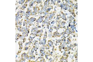 Immunohistochemistry of paraffin-embedded human lung cancer using ADSS antibody (ABIN6292806) at dilution of 1:100 (40x lens). (ADSS antibody)
