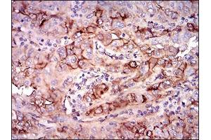 Immunohistochemical analysis of paraffin-embedded endometrial cancer tissues using NT5E mouse mAb with DAB staining. (CD73 antibody  (AA 30-250))