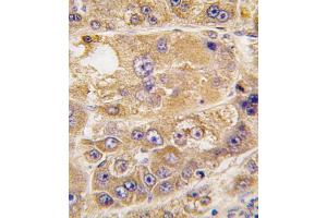 Formalin-fixed and paraffin-embedded human hepatocarcinoma tissue reacted with LDLR antibody (C-term) (ABIN392554 and ABIN2842101) , which was peroxidase-conjugated to the secondary antibody, followed by DAB staining. (LDLRAP1 antibody  (C-Term))