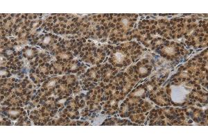 Immunohistochemistry of paraffin-embedded Human thyroid cancer tissue using SMAD7 Polyclonal Antibody at dilution 1:40 (SMAD7 antibody)