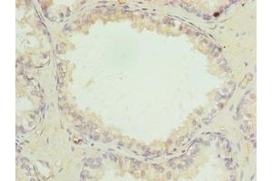 Immunohistochemistry of paraffin-embedded human prostate cancer using ABIN7158525 at dilution of 1:100