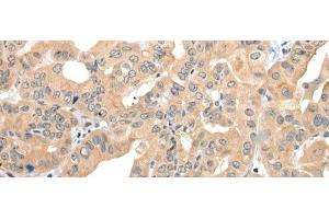 Immunohistochemistry of paraffin-embedded Human thyroid cancer tissue using CAGE1 Polyclonal Antibody at dilution of 1:35(x200) (CAGE1 antibody)