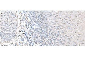 Immunohistochemistry of paraffin-embedded Human esophagus cancer tissue using EPM2A Polyclonal Antibody at dilution of 1:55(x200) (EPM2A antibody)