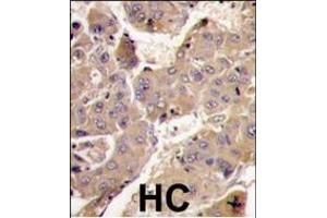 Formalin-fixed and paraffin-embedded human hepatocarcinoma tissue reacted with PIK3R3 antibody (C-term), which was peroxidase-conjugated to the secondary antibody, followed by DAB staining. (PIK3R3 antibody  (C-Term))