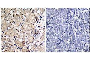 Immunohistochemical analysis of paraffin-embedded human breast carcinoma tissue using FKHR(Phospho-Ser319) Antibody(left) or the same antibody preincubated with blocking peptide(right). (FOXO1 antibody  (pSer319))