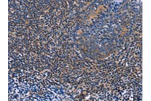 The image on the left is immunohistochemistry of paraffin-embedded Human tonsil tissue using ABIN7128290(AGFG1 Antibody) at dilution 1/60, on the right is treated with fusion protein. (AGFG1 antibody)