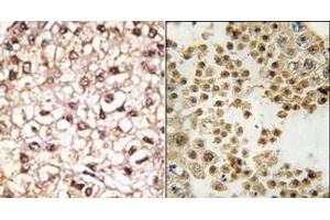 (LEFT)Formalin-fixed and paraffin-embedded human cancer tissue reacted with the primary antibody, which was peroxidase-conjugated to the secondary antibody, followed by AEC staining. (Parkin antibody  (N-Term))