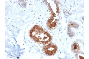 Formalin-fixed, paraffin-embedded human Breast Carcinoma stained with Mammaglobin Recombinant Rabbit Monoclonal Antibody (MGB1/2123R).