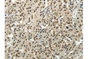 The image on the left is immunohistochemistry of paraffin-embedded Human breast cancer tissue using ABIN7189956(BAZ1B Antibody) at dilution 1/35, on the right is treated with synthetic peptide.