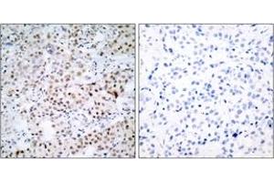 Immunohistochemistry analysis of paraffin-embedded human breast carcinoma tissue, using CREB (Ab-133) Antibody. (CREB1 antibody  (AA 100-149))