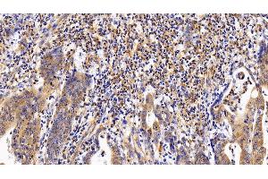 Detection of LIFR in Human Stomach cancer Tissue using Polyclonal Antibody to Leukemia Inhibitory Factor Receptor (LIFR) (LIFR antibody  (AA 522-691))