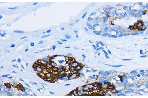 Immunohistochemistry of paraffin-embedded Human mammary cancer using EEA1 Polyclonal Antibody at dilution of 1:100 (40x lens). (EEA1 antibody)