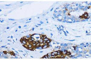 Immunohistochemistry of paraffin-embedded Human mammary cancer using EEA1 Polyclonal Antibody at dilution of 1:100 (40x lens). (EEA1 antibody)