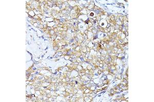 Immunohistochemistry of paraffin-embedded human mammary cancer using EIF3L antibody (ABIN6131772, ABIN6140074, ABIN6140075 and ABIN6225315) at dilution of 1:100 (40x lens).