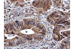 IHC-P Image Amphiregulin antibody detects Amphiregulin protein at cytoplasm in human colon cancer by immunohistochemical analysis. (Amphiregulin antibody)