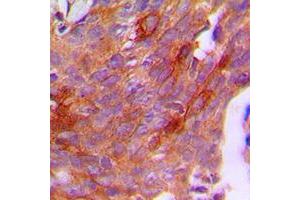 Immunohistochemical analysis of CG beta staining in human breast cancer formalin fixed paraffin embedded tissue section. (CGB antibody  (C-Term))