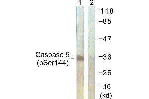 Immunohistochemistry analysis of paraffin-embedded human breast carcinoma using Caspase 9 (Phospho-Ser144) antibody. (Caspase 9 antibody  (pSer144))