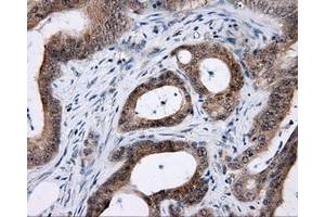 Immunohistochemical staining of paraffin-embedded Carcinoma of prostate tissue using anti-LIPG mouse monoclonal antibody. (LIPG antibody)
