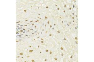 Immunohistochemistry of paraffin-embedded human esophageal cancer using HDAC3 Antibody. (HDAC3 antibody  (AA 299-428))