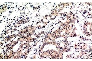 Immunohistochemistry of paraffin-embedded Human breast carcinoma tissue using Ubiquitin Monoclonal Antibody at dilution of 1:200. (Ubiquitin antibody)