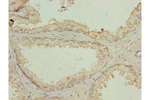 Immunohistochemistry of paraffin-embedded human prostate cancer using ABIN7161122 at dilution of 1:100 (N4BP2L2 antibody  (AA 1-300))