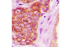 Immunohistochemical analysis of PKC mu (pY463) staining in human breast cancer formalin fixed paraffin embedded tissue section. (PKC mu antibody  (pTyr463))