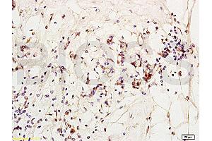Formalin-fixed and paraffin embedded human breast carcinoma labeled with Anti-MCP-2 Polyclonal Antibody, Unconjugated (ABIN676283) at 1:200 followed by conjugation to the secondary antibody and DAB staining (CCL8 antibody  (AA 24-99))