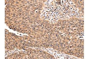 The image on the left is immunohistochemistry of paraffin-embedded Human lung cancer tissue using ABIN7193106(ZNF146 Antibody) at dilution 1/20, on the right is treated with synthetic peptide. (ZNF146 antibody)