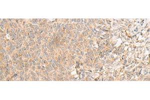 Immunohistochemistry of paraffin-embedded Human ovarian cancer tissue using RNF207 Polyclonal Antibody at dilution of 1:40(x200) (RNF207 antibody)