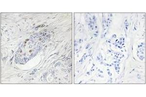 Immunohistochemistry analysis of paraffin-embedded human breast carcinoma, using ZNF232 Antibody. (ZNF232 antibody  (AA 171-220))