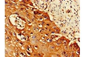 Immunohistochemistry of paraffin-embedded human cervical cancer using ABIN7164944 at dilution of 1:100 (PSMA1 antibody  (AA 163-263))