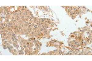 Immunohistochemistry of paraffin-embedded Human lung cancer tissue using ASCL1 Polyclonal Antibody at dilution 1:30 (ASCL1 antibody)