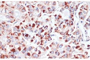 Immunohistochemistry of paraffin-embedded Human liver cancer using TFRC Polyclonal Antibody at dilution of 1:100 (40x lens). (Transferrin Receptor antibody)
